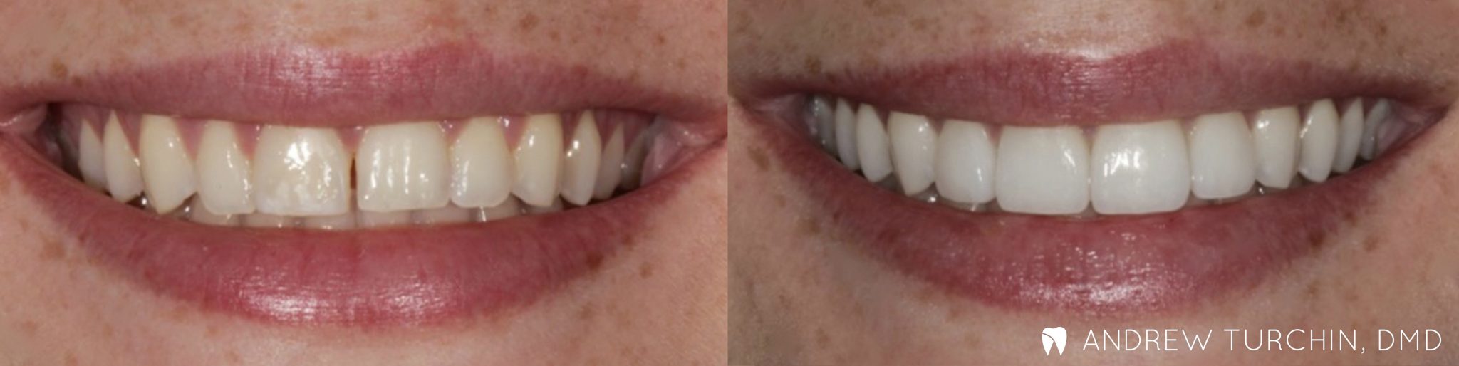 before & after dental photos