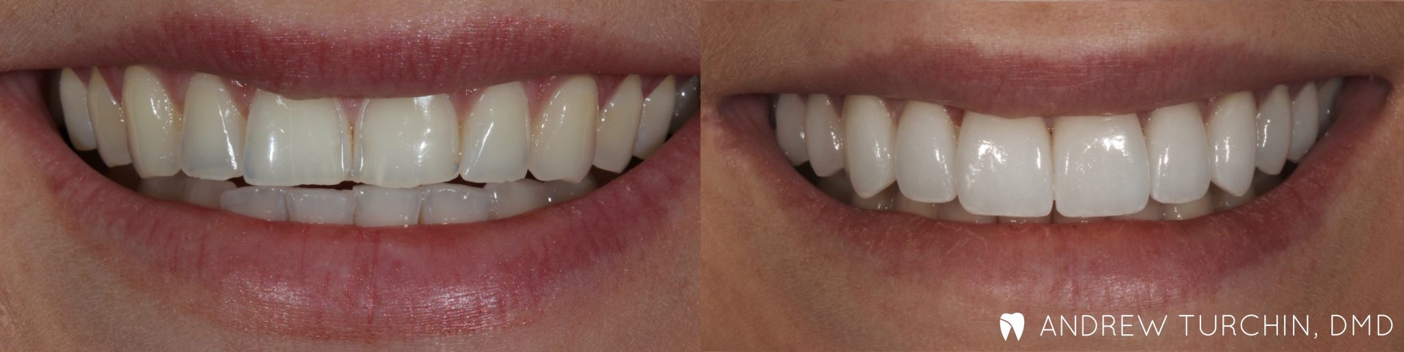 before & after dental photos