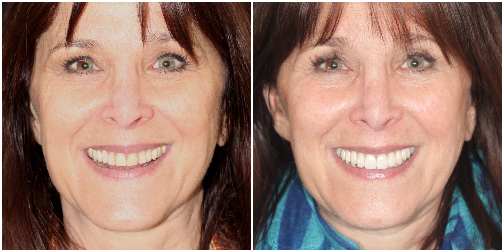 cosmetic treatment before and after aspen co