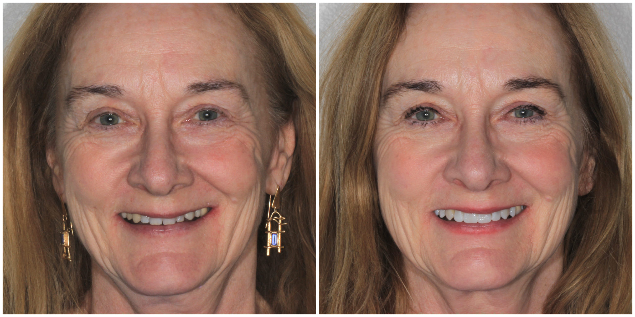 aspen co full scale before & after cosmetic dental treatment