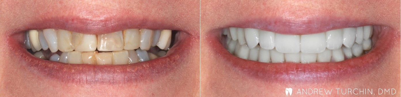 before and after 6 dentist aspen co