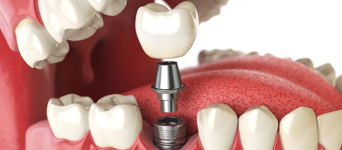 dental implants image aspen