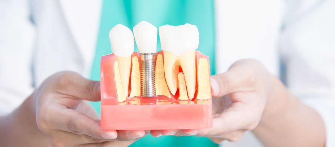 dental implants aspen co