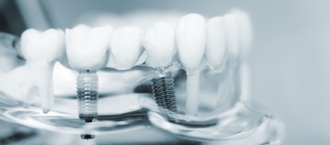 dental implants aspen co